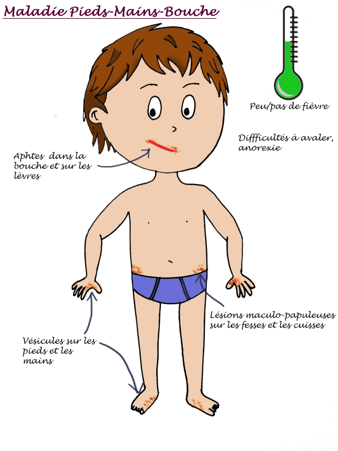 syndrome pieds mains bouche contagion syndrome pieds mains bouche contagion